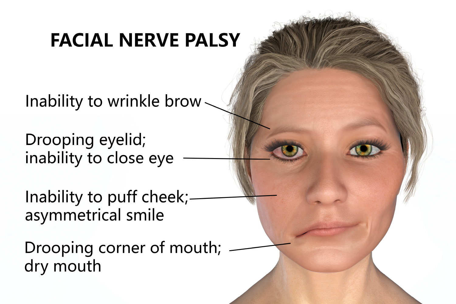 bell's palsy
